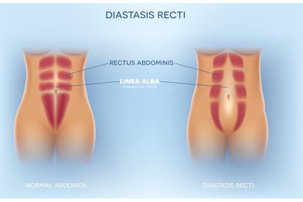 What Non-Surgical Options Are Available for Diastasis Recti Glenrothes?
