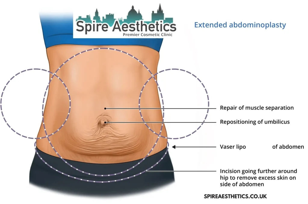 Understanding Loose Skin After Gastric Band Glenrothes Surgery and HIFU Treatment