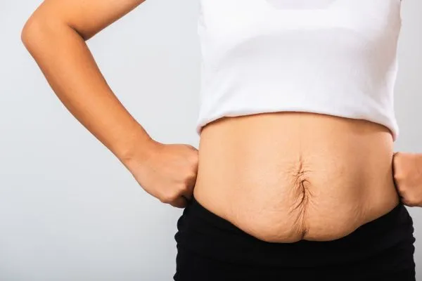 Image of a woman's stomach after weight loss with sagging skin following a gastric band Glenrothes