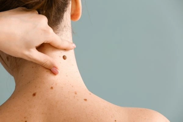 skin blemish removal Glenrothes treatment