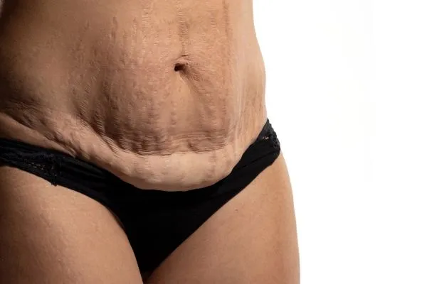 Image of womans stomach after weight loss injections Glenrothes showing saggy skin